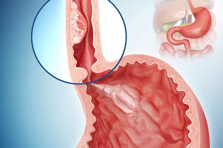 Những nguyên nhân gây u nhú thực quản hàng đầu