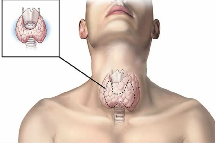 U tuyến giáp có gây nguy hiểm không?