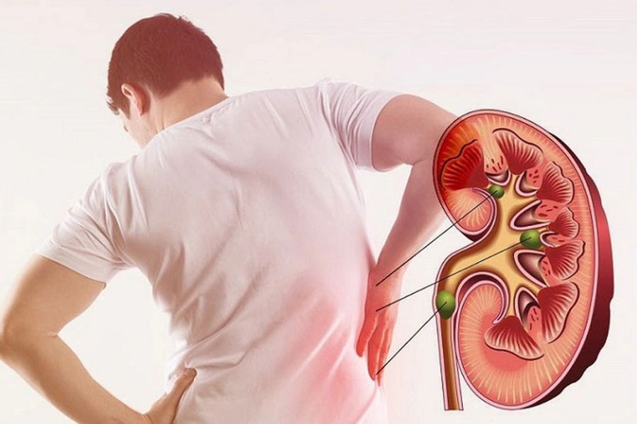 Những ai không nên uống tảo biển? Người đang mắc bệnh thận