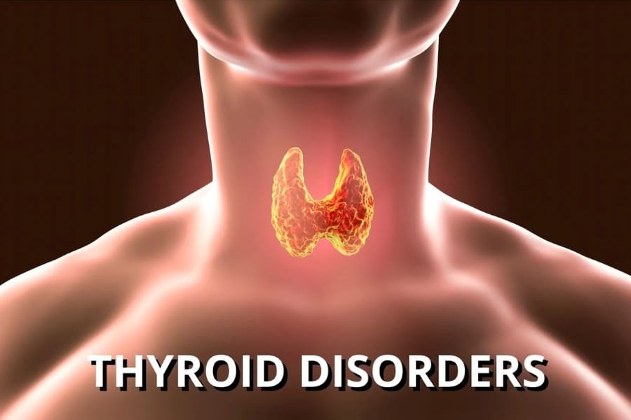 U tuyến giáp có lây không? 2 cách điều trị 3 lưu ý