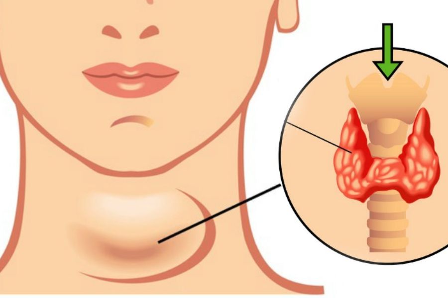 Bệnh tuyến giáp thường gặp là suy giáp