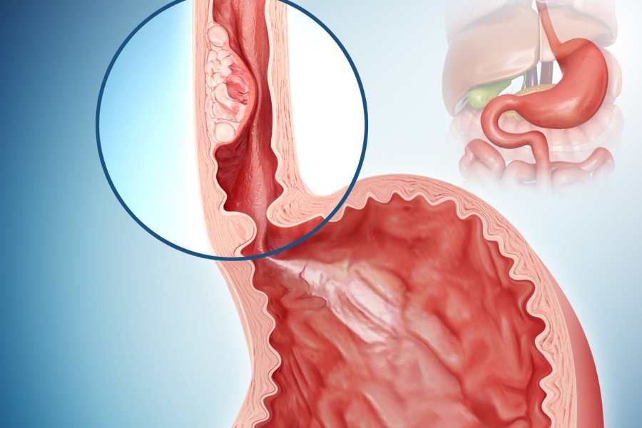 Thông qua ống nội soi, bác sĩ sẽ bơm một lượng chất lỏng vào vị trí có tế bào ung thư
