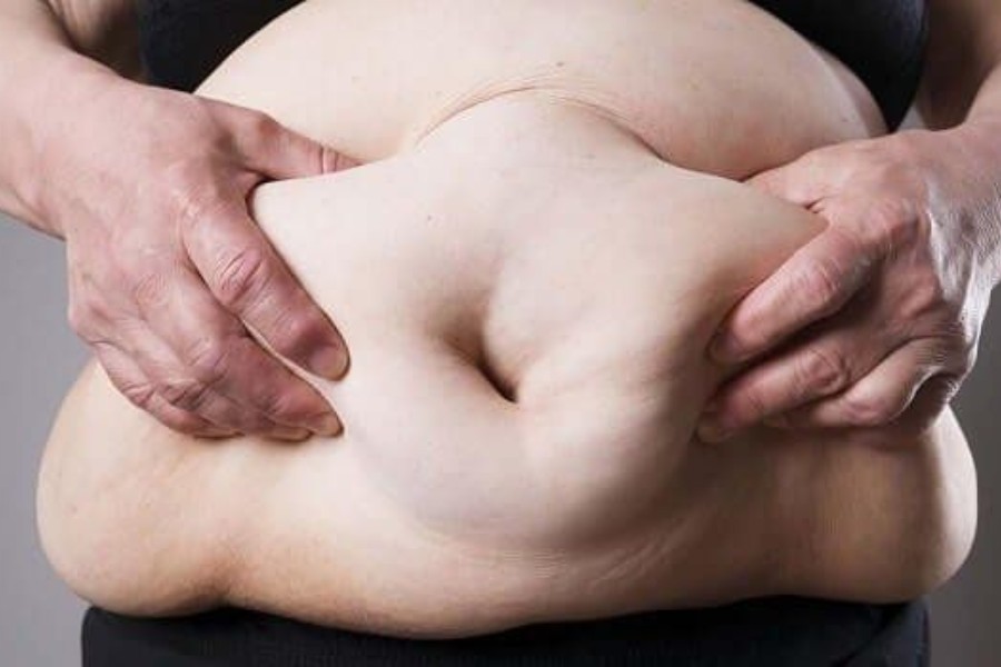 Người bị thừa cân, béo phì dễ bị viêm thực quản trào ngược độ A