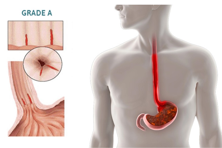 Viêm thực quản trào ngược độ A là gì? là hậu quả của bệnh trào ngược dạ dày – thực quản