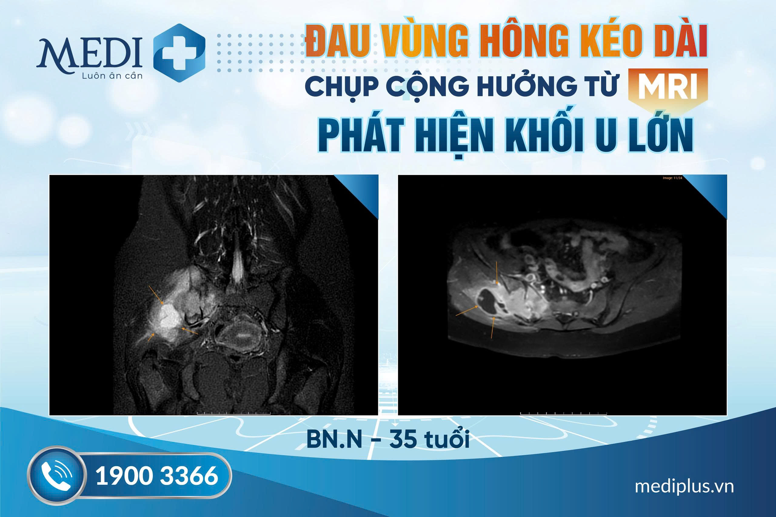 Chụp MRI phát hiện khối u lớn – Đừng chủ quan với những cơn đau hông kéo dài