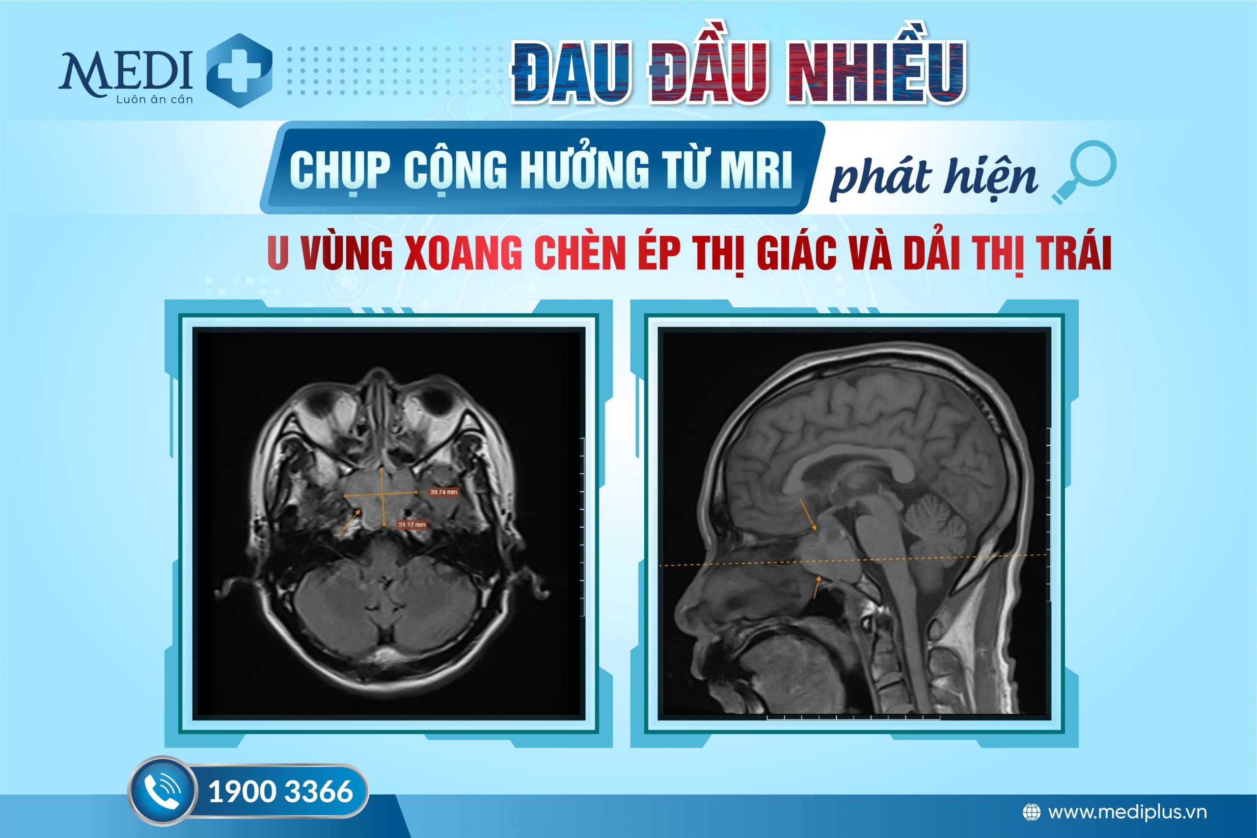 Đau đầu, mờ mắt – Triệu chứng ban đầu của U não!