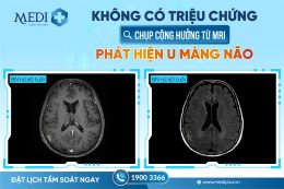 Người phụ nữ 60 tuổi phát hiện u màng não dù không có triệu chứng
