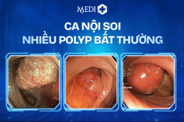 NỘI SOI PHÁT HIỆN POLYP RẢI RÁC – CẢNH BÁO NGUY CƠ BỆNH LÝ TIỀM ẨN 