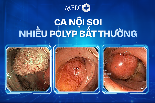 NỘI SOI PHÁT HIỆN POLYP RẢI RÁC – CẢNH BÁO NGUY CƠ BỆNH LÝ TIỀM ẨN 