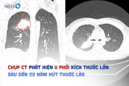 Chụp CT phát hiện u phổi kích thước lớn sau gần 20 năm hút thuốc lào