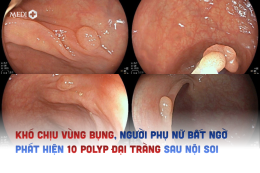 Khó chịu vùng bụng, người phụ nữ bất ngờ phát hiện 10 polyp đại tràng sau nội soi