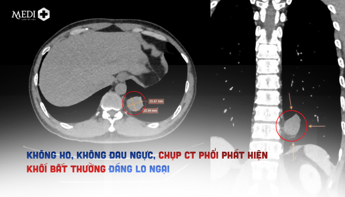 Không ho, không đau ngực, chụp CT phổi phát hiện khối bất thường đáng lo ngại