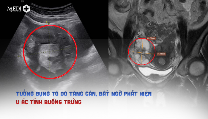 Tưởng bụng to do tăng cân, người phụ nữ 43 tuổi bất ngờ phát hiện u ác tính buồng trứng