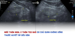 [NAM ĐỊNH] Chủ quan không uống thuốc huyết áp, đi khám phát hiện bệnh thận mạn, 2 thận teo nhỏ