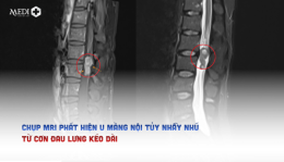Chụp MRI phát hiện u màng nội tủy nhầy nhú từ cơn đau lưng kéo dài