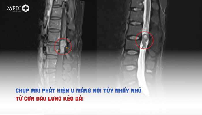 Chụp MRI phát hiện u màng nội tủy nhầy nhú từ cơn đau lưng kéo dài