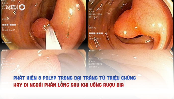 [NAM ĐỊNH] Phát hiện 8 polyp đại tràng từ triệu chứng hay đi ngoài phân lỏng sau khi uống rượu bia