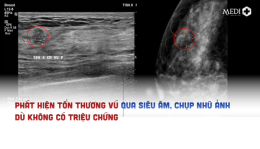 Ung thư vú tiến triển “âm thầm”: Lý do phụ nữ cần tầm soát định kỳ ngay cả khi không có triệu chứng